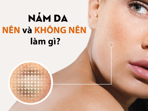 Bị nám có dễ điều trị hay không?